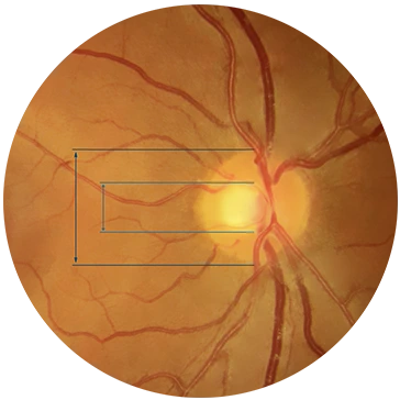 Fondo de ojo con glaucoma