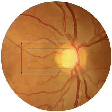 Fondo de ojo con glaucoma
