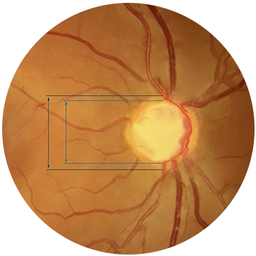Fondo de ojo con glaucoma