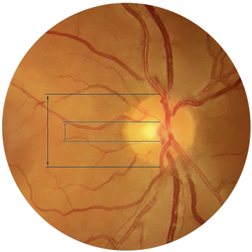 Fondo de ojo con glaucoma